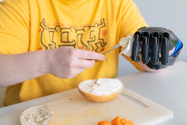 Lisa übt mit ihrer Teilhandprothese bei protheofit