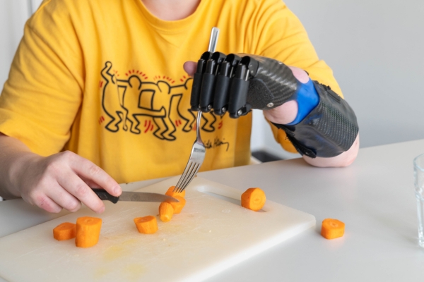 Lisa übt mit ihrer Teilhandprothese um alltägliche Funktionen zu meistern