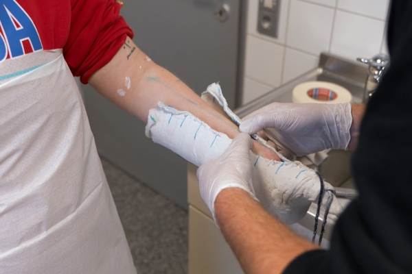 Lisa wird für Teilhandprothese vermessen