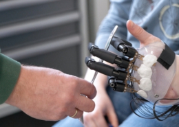 Neue Möglichkeiten mit Teilhandprothese